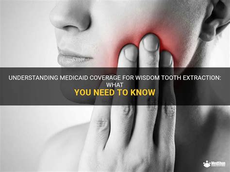 Understanding If Wisdom Tooth Extraction Is Covered .